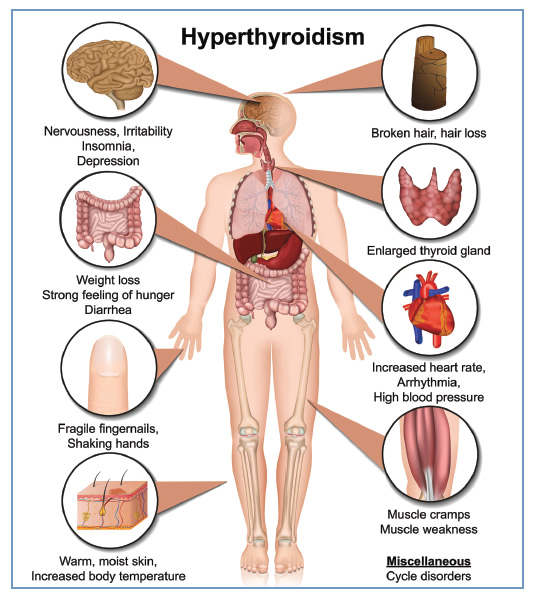 Hyperthyroidism American Thyroid Association